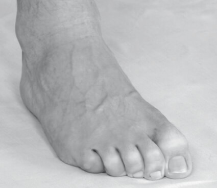 Sintomatologia spastica (piedi) – Dita dei piedi in flessione