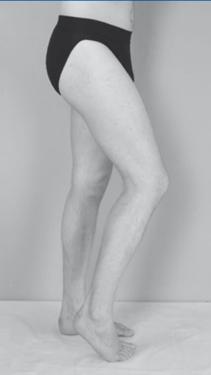 Sintomatologia spastica (arti inferiori) – Anca e ginocchio in flessione