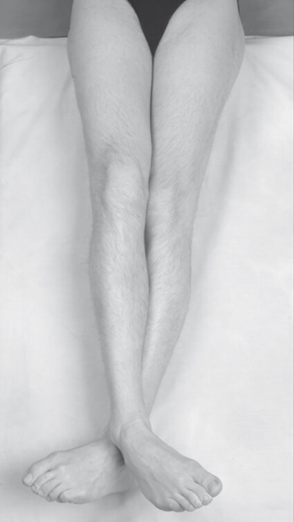 Sintomatologia spastica (arti inferiori) – Anca e ginocchio in estensione