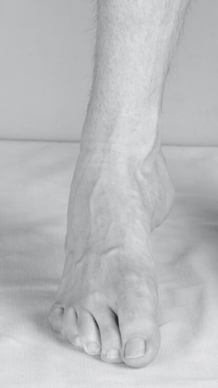 Sintomatologia spastica (piedi) – Piede varo spastico