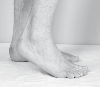 Sintomatologia spastica (piedi) – Piede equino spastico