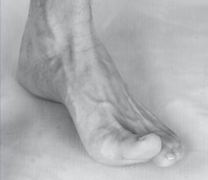 Sintomatologia spastica (piedi) – Alluce in iperestensione