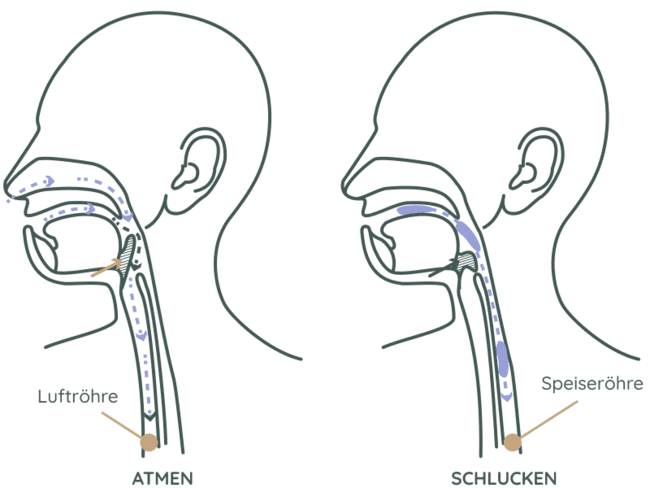 Unterschied Atmen vs. Schlucken: Speichelfluss bei Schluckstörung kann in Luftröhre gelangen und Sialorrhoe oder Aspiration verursachen
